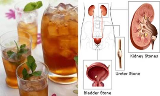 Iced Tea Can Develop Kidney Stones