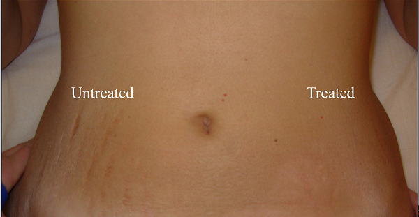 Stretch marks or striae are a form of scarring on the skin.