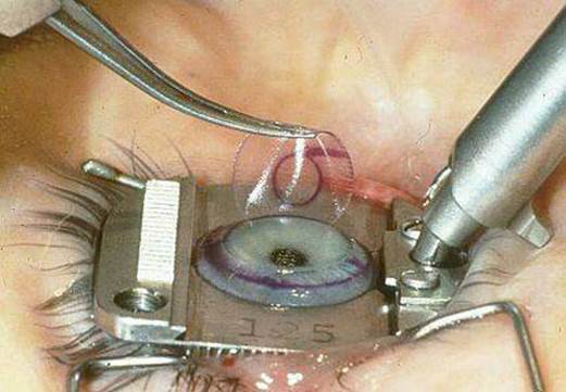 Lasik surgery is not always applicable for all short-sighted patients...