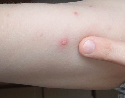 Description: Chicken pox is an unpleasant disease.