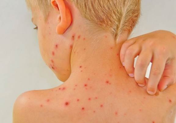 Description: Try not to scratch chickenpox or you’ll have scars in later time.