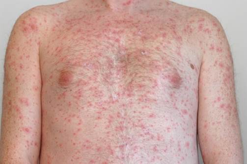 Description: Chicken pox patients often get 400-500 chickenpox.