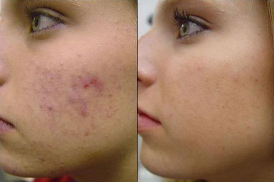 Description: “Acne scars are very challenging to get rid of,” says Dr. Philip Bekhor, director of the Laser Unit at the Royal