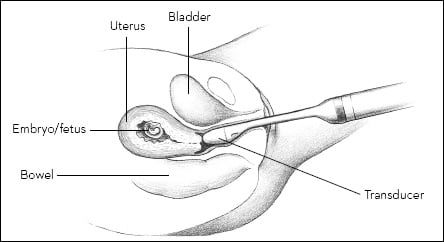 Vaginal probe ultrasound