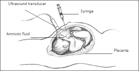 Amniocentesis near the end of pregnancy can determine if a baby’s lungs are mature