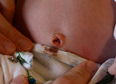 If baby’s button bleeds, parents need to bring him/ her to hospital right away.