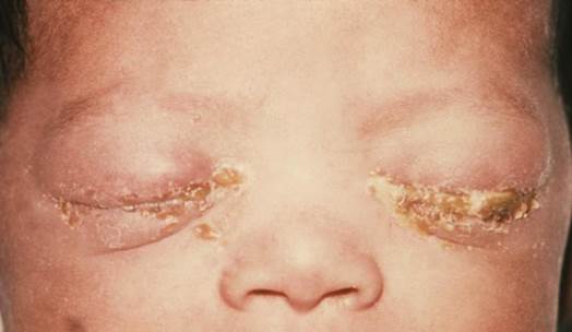 The symptoms often appear in the third day after birth and happen to 2 eyes.