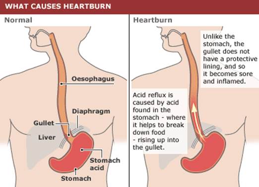 Description: Heartburn symptom