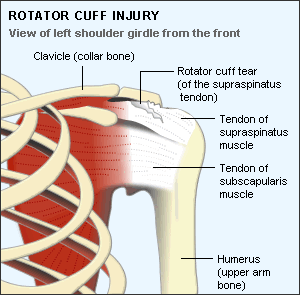 Description: Rotator cuff tear