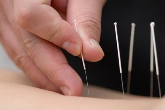 Description: Acupuncture 