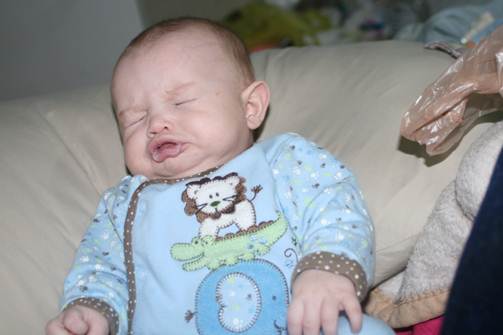 Sneezing is a symptom of nasopharyngitis.
