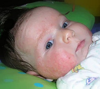Description: Eczema is a common disease in children.