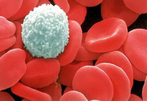 Description: Description: Blood cancer (acute lymphoblastic leukemia) White Blood Cells develop in the stem cells in the bone marrow.