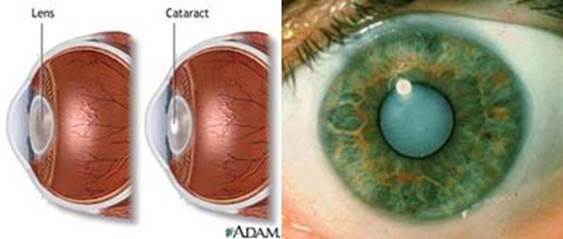 People that have cataract will make the risk of heart disease increase.