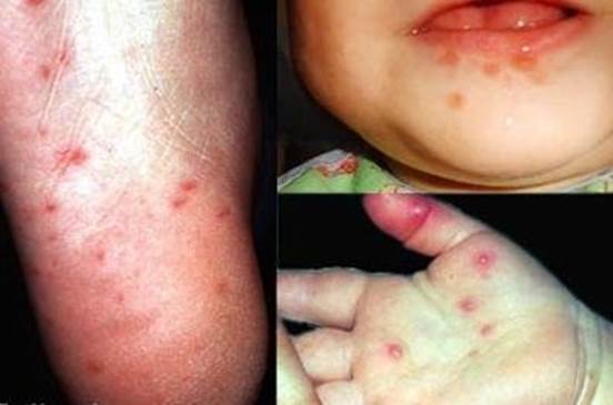 Hand-foot-mouth disease is very popular and it isn’t often serious.