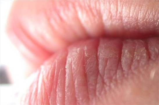 Dry and chapped lips will make you uncomfortable.