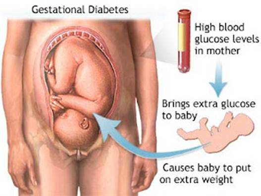 Description: Diagnosis of diabetes during pregnancy