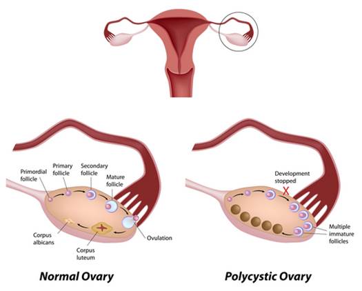 In many women who have the disorder the ovaries are enlarged and feature numerous small cysts along the outer edge of each ovary