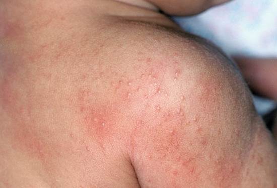 Skin rash is a popular skin issue to children.
