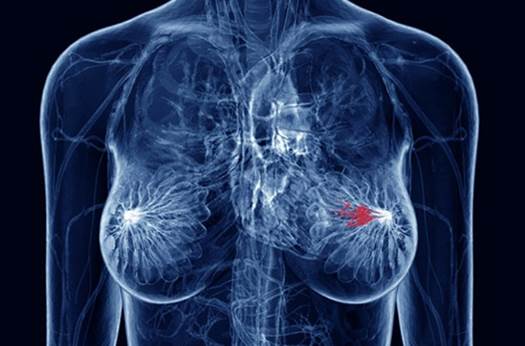 If you mother have breast cancer, you are twice as high risk as people who don’t.