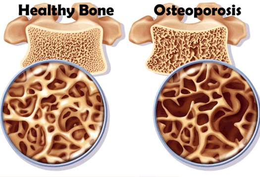 Bone structures are much affected by genetic factors have considerable correlations about the size, thickness and density.