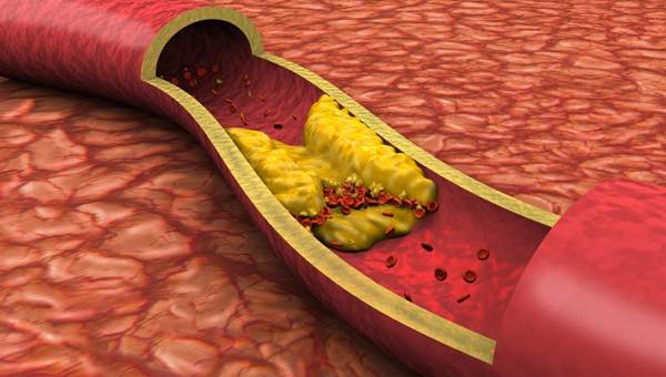 Description: Atherosclerosis occurs when matters called plaques start accumulate at the artery wall.