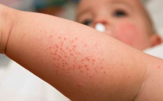 Be careful with red spots on babies’ body.