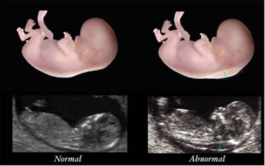 What Do Pregnant Women Know About Nuchal Translucency Test?